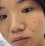 韩方五谷壬二酸祛痘膏胶态硫凝胶去痘痘淡印痘坑水杨酸祛痘青春期学生专用 实拍图