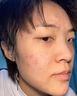 白云山壬二酸祛痘面膜10片淡化痘印控油祛痘毛孔收缩补水保湿男女士 实拍图