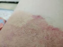股藓大腿内侧真菌感染腹股沟股癣膏大腿根内测潮湿瘙痒癣药水喷雾专用药真菌感染皮肤用药盐酸特比萘芬喷雾剂 3盒【股癣反复痒】【视觉特效】 实拍图