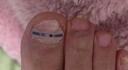 Dr.JYS甲沟炎矫正器钛合金硅胶款指甲长肉里嵌甲专用正甲贴片 实拍图