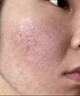 代文脸上坑坑洼洼痘坑痘印痘疤男士凹洞凹陷疤痕可搭祛痘修复凝胶CN 【1盒】青少年男士女士通用 实拍图