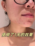 韩方五谷壬二酸祛痘膏胶态硫凝胶去痘痘淡印痘坑水杨酸祛痘青春期学生专用 实拍图