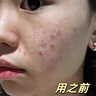 维特丝壬二酸祛痘膏烟酰胺凝胶去痘痘淡痘坑水杨酸青少年学生专用青春痘 实拍图