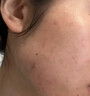 藤石制药腮边痘硬块痘淋巴痘专用祛痘膏下巴硬块红肿搭药脖子脸颊两边Q3 一盒痤疮霜 送棉签【 淋巴腮边痤疮痘】 实拍图