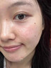 维特丝愈创木祛痘精华淡化痘印去痘痘收毛孔男女士护肤品青春期学生专用 实拍图