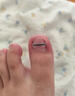 Dr.JYS甲沟炎矫正器钛合金硅胶款指甲长肉里嵌甲专用正甲贴片 实拍图