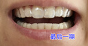 曙美（SHUMEI）牙齿矫正器透明隐形牙套矫正龅牙牙缝地包天牙齿不齐矫治器定制 德国进口材质，效果更明显 咨询客服  了解活动，分析牙齿 实拍图