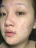 维特丝愈创木祛痘精华淡化痘印去痘痘收毛孔男女士护肤品青春期学生专用 实拍图