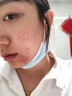 代文脸上坑坑洼洼痘坑痘印痘疤男士凹洞凹陷疤痕可搭祛痘修复凝胶CN 【1盒】青少年男士女士通用 实拍图
