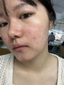 透真祛痘次抛精华液淡化痘印收缩毛孔舒缓泛红痤疮无水杨酸青春期学生 实拍图
