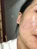 藤石制药腮边痘硬块痘淋巴痘专用祛痘膏下巴硬块红肿搭药脖子脸颊两边Q3 一盒痤疮霜 送棉签【 淋巴腮边痤疮痘】 实拍图
