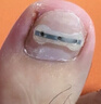 Dr.JYS甲沟炎矫正器钛合金硅胶款指甲长肉里嵌甲专用正甲贴片 实拍图