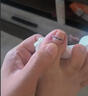 Dr.JYS甲沟炎矫正器钛合金硅胶款指甲长肉里嵌甲专用正甲贴片 实拍图