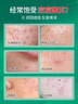 SEEDONVEUR医研痘痘贴吸脓消炎隐形遮瑕抗痘祛痘化妆水胶体贴圆形透明108贴 实拍图