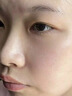 医用精华液械字号收缩毛孔粗大修复细致去黑头粉刺闭口男士女士祛痘印黑色素沉淀控油淡化痘印痘坑透明质酸钠 实拍图