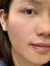 医用精华液械字号收缩毛孔粗大修复细致去黑头粉刺闭口男士女士祛痘印黑色素沉淀控油淡化痘印痘坑透明质酸钠 实拍图
