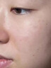 医用精华液械字号收缩毛孔粗大修复细致去黑头粉刺闭口男士女士祛痘印黑色素沉淀控油淡化痘印痘坑透明质酸钠 实拍图