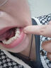 爱本丘牙冠全瓷牙套威兰德3M拉瓦泽康二氧化锆补镶牙烤瓷牙爱尔创全瓷牙 吉尔巴赫全瓷牙 实拍图