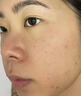 医用精华液械字号收缩毛孔粗大修复细致去黑头粉刺闭口男士女士祛痘印黑色素沉淀控油淡化痘印痘坑透明质酸钠 晒单实拍图