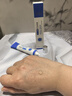 OHBT壬二酸祛痘药膏水杨酸凝胶祛痘痘和淡化痘印坑消炎痤疮专用青少年 实拍图