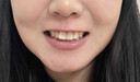 曙美（SHUMEI）牙齿矫正器透明隐形牙套矫正龅牙牙缝地包天牙齿不齐矫治器定制 德国进口材质，效果更明显 咨询客服  了解活动，分析牙齿 实拍图