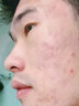 维特丝愈创木祛痘精华淡化痘印去痘痘收毛孔男女士护肤品青春期学生专用 实拍图