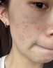 维特丝愈创木祛痘精华淡化痘印去痘痘收毛孔男女士护肤品青春期学生专用 实拍图