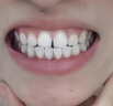 曙美（SHUMEI）牙齿矫正器透明隐形牙套矫正龅牙牙缝地包天牙齿不齐矫治器定制 德国进口材质，效果更明显 咨询客服  了解活动，分析牙齿 实拍图
