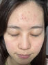 SUMDOY日本进口祛痘膏精华液淡化痘印痘坑祛痘印修复红肿痘疤男女士凝胶 【红肿痘克星】一支见效30g 实拍图
