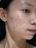 维特丝愈创木祛痘精华淡化痘印去痘痘收毛孔男女士护肤品青春期学生专用 实拍图