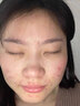 维特丝愈创木祛痘精华淡化痘印去痘痘收毛孔男女士护肤品青春期学生专用 实拍图