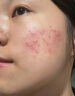 维特丝愈创木祛痘精华淡化痘印去痘痘收毛孔男女士护肤品青春期学生专用 实拍图