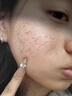 痘印痘坑修复凹洞祛痘去痘印去闭口粉刺去黑头痘坑男士祛痘疤膏药 (发货特效)买2送1【痘坑痘印凹洞】可试用 去痘痘和痘印淡化消除填充再生凝胶生长因子女男生医用 实拍图