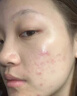 维特丝愈创木祛痘精华淡化痘印去痘痘收毛孔男女士护肤品青春期学生专用 实拍图