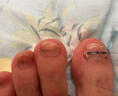Dr.JYS甲沟炎矫正器镍钛合金正甲贴片嵌甲专用脚趾甲长肉里足部固定器 实拍图