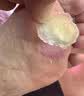 胖东来代购去老茧去脚底老茧去硬皮老茧软化膏茧子去除脚钉专佣用药去茧 1盒云南本草鸡茧膏软化角质去硬皮 实拍图