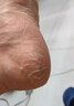 角化型脚气顽固性真菌感染角质增厚脚后跟干裂专用药脚脱皮去真菌皮肤干裂脱皮厚硬手足鳞屑型硝酸咪康唑乳膏 1盒【足跟粗糙开裂脱皮】主图视觉特效 实拍图