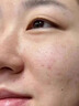 医用精华液械字号收缩毛孔粗大修复细致去黑头粉刺闭口男士女士祛痘印黑色素沉淀控油淡化痘印痘坑透明质酸钠 实拍图