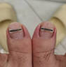 Dr.JYS钛合金甲沟炎矫正器神指甲长肉里嵌甲纠正专用正甲贴片 实拍图