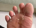 DR.SCT脚气喷雾剂止痒脱皮烂脚丫真菌感染去除脚臭脚气克星可搭软膏1盒 实拍图
