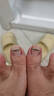 Dr.JYS钛合金甲沟炎矫正器神指甲长肉里嵌甲纠正专用正甲贴片 实拍图