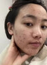 维特丝愈创木祛痘精华淡化痘印去痘痘收毛孔男女士护肤品青春期学生专用 实拍图