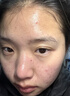 韩方五谷壬二酸祛痘药膏祛痘淡化痘印烟酰胺凝胶水杨酸胶态硫青春期学生 实拍图