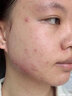 维特丝愈创木祛痘精华淡化痘印去痘痘收毛孔男女士护肤品青春期学生专用 实拍图