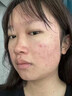 维特丝愈创木祛痘精华淡化痘印去痘痘收毛孔男女士护肤品青春期学生专用 实拍图