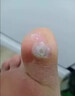 脚医生鸡眼膏10ml/盒鸡尤净脚底跖疣成人去脚根低老茧鸡眼贴手部脚趾 实拍图