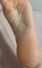 角化型脚气顽固性真菌感染角质增厚脚后跟干裂专用药脚脱皮去真菌皮肤干裂脱皮厚硬手足鳞屑型硝酸咪康唑乳膏 1盒【足跟粗糙开裂脱皮】主图视觉特效 实拍图