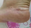 角化型脚气顽固性真菌感染角质增厚脚后跟干裂专用药脚脱皮去真菌皮肤干裂脱皮厚硬手足鳞屑型硝酸咪康唑乳膏 1盒【足跟粗糙开裂脱皮】主图视觉特效 实拍图