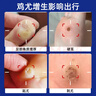 同仁堂鸡眼贴鸡眼膏去脚跟肉刺药膏无痛脱落连根拔去脚底老茧硬皮跖疣贴 实拍图