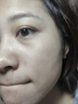 医用精华液械字号收缩毛孔粗大修复细致去黑头粉刺闭口男士女士祛痘印黑色素沉淀控油淡化痘印痘坑透明质酸钠 实拍图